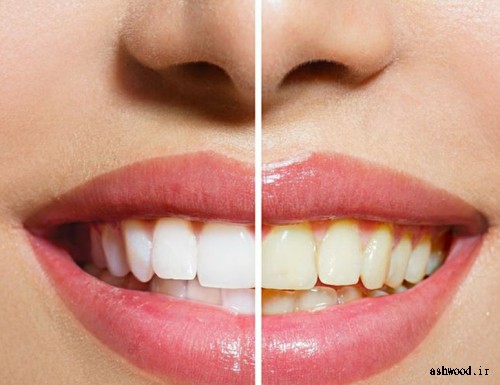 دندان‌های زرد سن را زیاد نشان می‌دهد